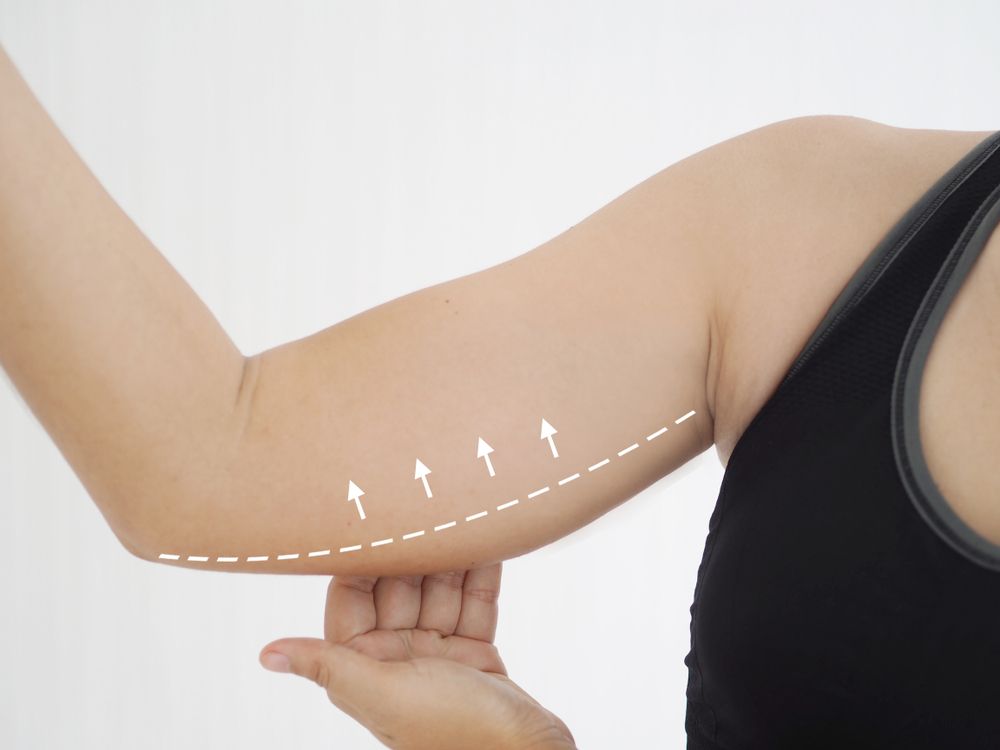 Arm Fat Removal Nearby
