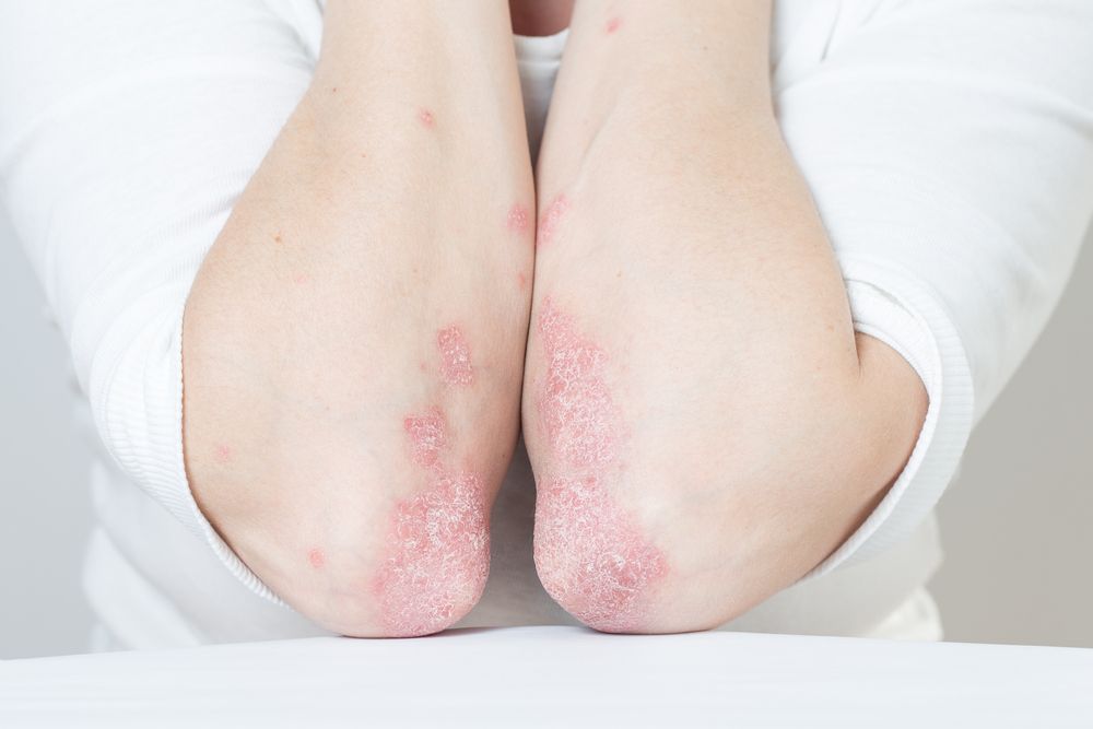 Understanding Plaque Psoriasis: Causes and Insights