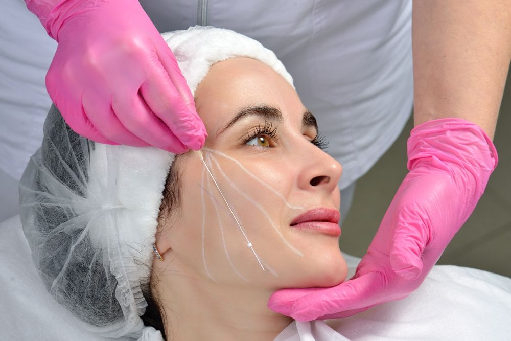 All You Need to Know About Thread Face Lift